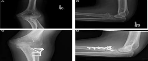 Corrective Osteotomy For Symptomatic Radial Head And Neck Ma