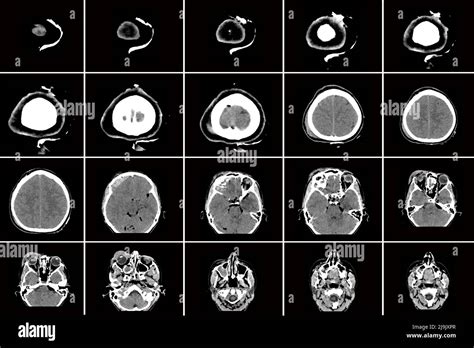 Tomograf A Computarizada Del Cerebro Con Fractura De La Parte Frontal