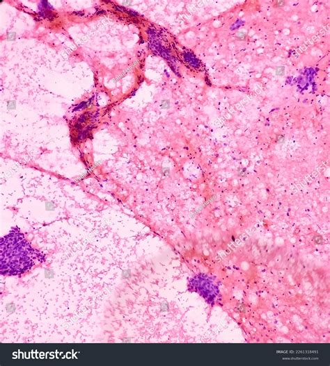 62 Atypical Hyperplasia Images, Stock Photos & Vectors | Shutterstock