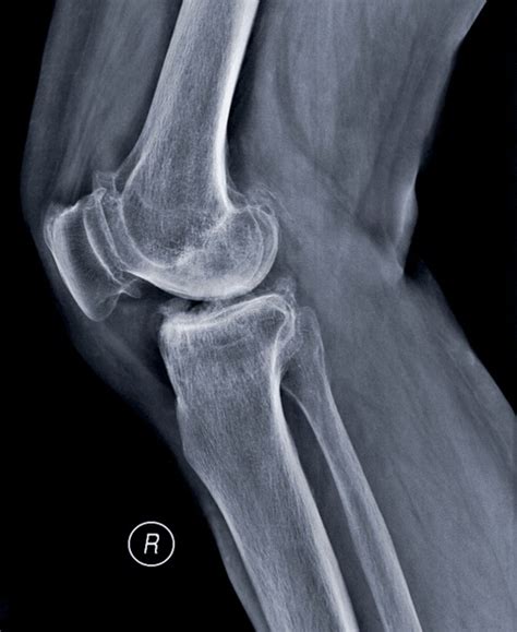 10 En La Categoría Calcification Meniscus De Fotos E Imágenes De Stock Libres De Regalías