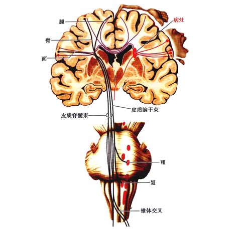 神内临床笔记11 胼胝体病变 知乎