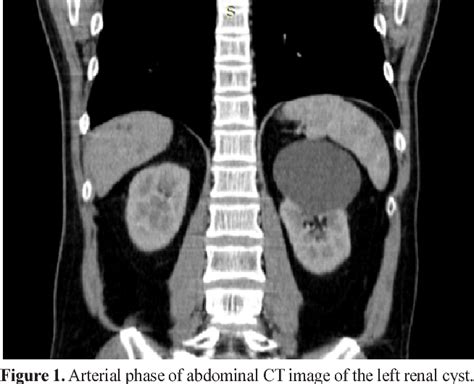 Figure 1 From Retroperitoneal Laparoendoscopic Single Site Approach For