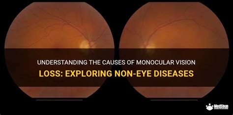 Understanding The Causes Of Monocular Vision Loss Exploring Non Eye