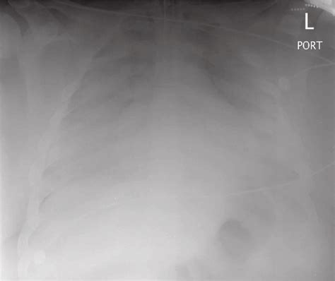 Presenting Portable Ap Chest Radiograph Download Scientific Diagram