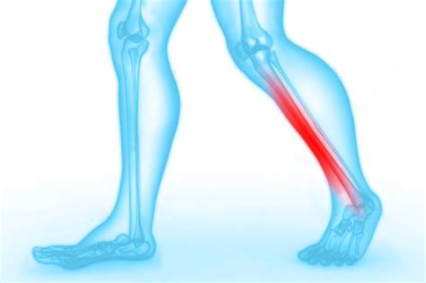 Shin splints Gáán Podotherapie