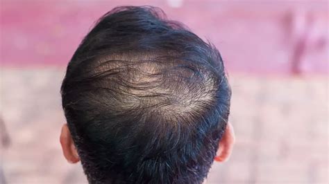 Understanding Hair Miniaturization: Causes, Signs, and Treatment Options