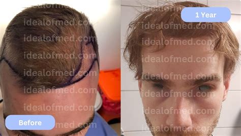 Hair Transplant Results After 2 Months Before After Images