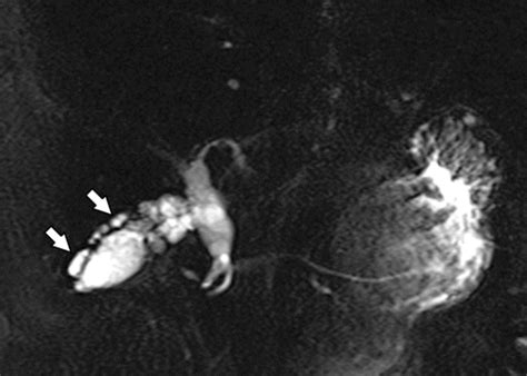 gallbladder carcinoma   differential diagnosis  mri