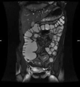 Exámenes diagnósticos para la enfermedad de Crohn