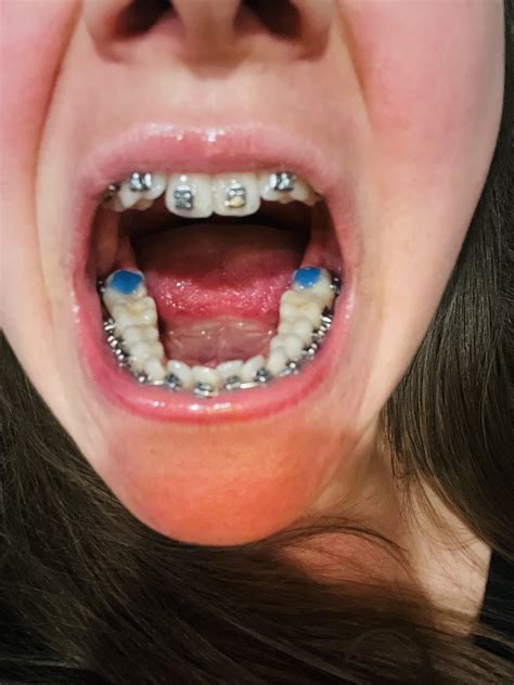 Does anyone have braces and an ortho night guard? : r/bruxism