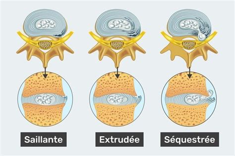 Hernie Discale Types Sympt Mes Causes Et Traitement Tua Sa De