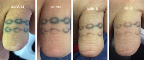 Top 168 + 100 tca peel tattoo removal - Spcminer.com