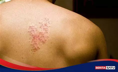 Pentingnya Vaksinasi Cacar Air Untuk Mencegah Herpes Zoster