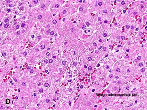 American Urological Association Adrenocortical Hyperplasia