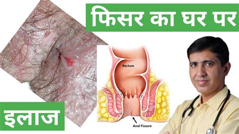 Fissure Treatment At Home In Hindi Fissure Treatment In Homeopathy Fissure Ano Symptoms