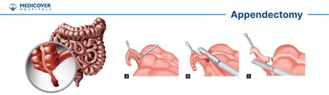 Apendicectom A Indicaciones Procedimientos Recuperaci N Y Estilo De Vida