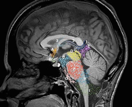 Cistern of the lamina terminalis | Radiology Reference Article ...