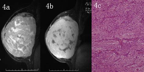 Imaging Findings In Phyllodes Tumors Of The Breast European Journal