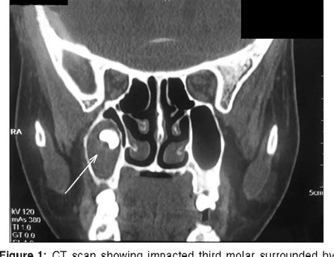 Figure 1 From Dentigerous Cyst With An Impacted Third Molar