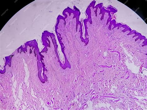 Biopsia Histológica De Pared Escrotal Bajo Microscopía Que Muestra