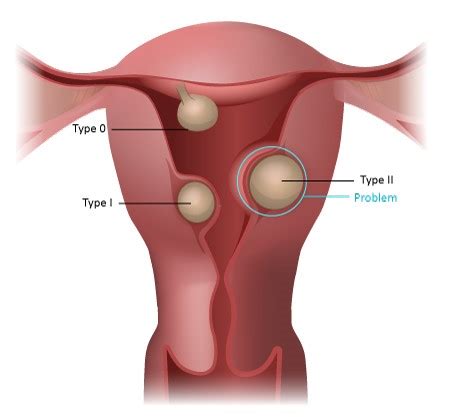 Submucosal Fibroids Uterine Fibroids Kjk Hospital Trivandrum