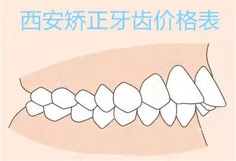 西安矫正牙齿价格表想看西安隐形牙套金属正畸多少钱的来 儿牙 妈妈好孕网