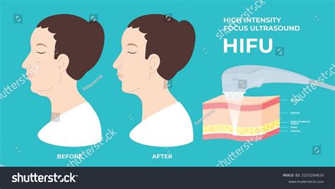 10 Hifu Before After Images, Stock Photos & Vectors | Shutterstock