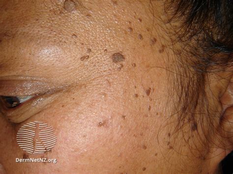 Figure Dermatosis Papulosa Nigra Dermnet New Zealand Statpearls