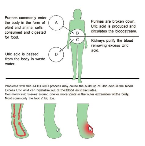 gout in ankle treatment