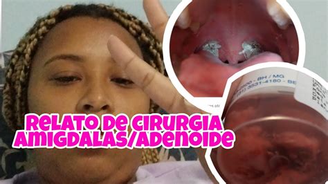 RELATO DA CIRURGIA DA AMIGDALAS E ADENÓIDE foi muito doloroso o pós