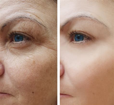 Photofacial Misaki Skin Hair And Laser Centre