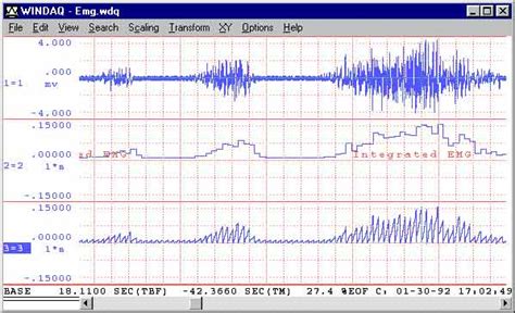 EMG Waveform Analysis with Advanced CODAS