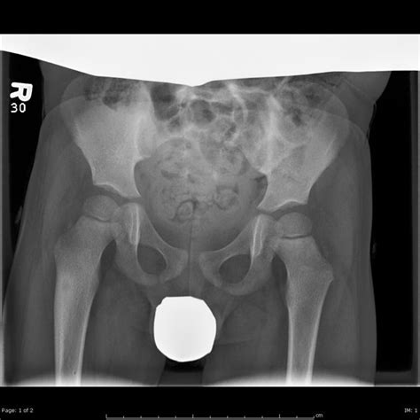 AP And Frog Leg Lateral Radiographs Of The Pelvis Show A Cortical Based