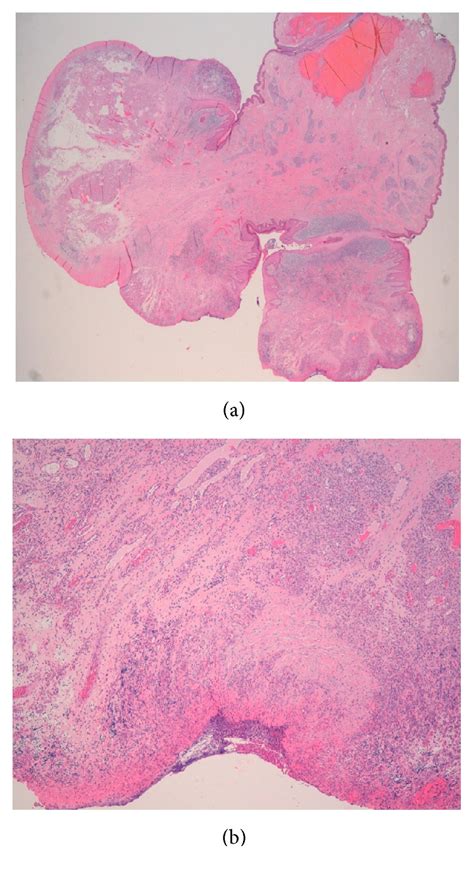 Vulvar Lobular Capillary Hemangioma A Rare Location For A Frequent Entity Pmc