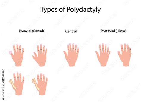 illustration of biology and medical, Types of polydactyly, Symptoms of ...