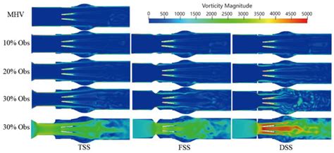 Bioengineering Free Full Text Hemodynamic Effects Of Subaortic