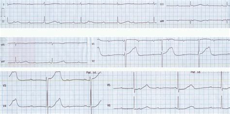 Complete Heart Block Narrow Qrs All About Cardiovascular System And