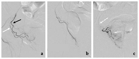 JCM Free Full Text Prostate Artery EmbolizationReview Of