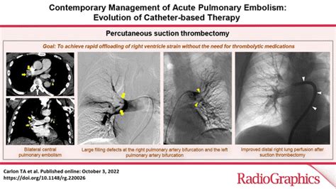 Contemporary Management Of Acute Pulmonary Embolism Evolution Of