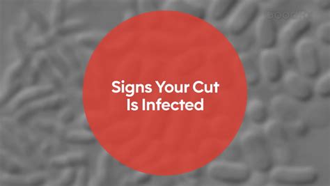 Is Your Cut Infected? Symptoms You Shouldn’t Ignore - GoodRx