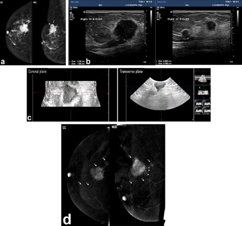 A Left Breast Lump Detected In A Diagnostic Mammogram Of A 39 Year Old