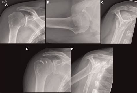 Figure 6 From Bridging Allograft Reconstruction Is Superior To Maximal