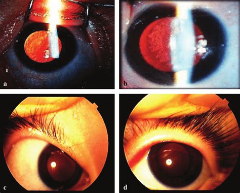 Peripherally Localised Posterior Subcapsular Cataracts A C Right Download Scientific Diagram