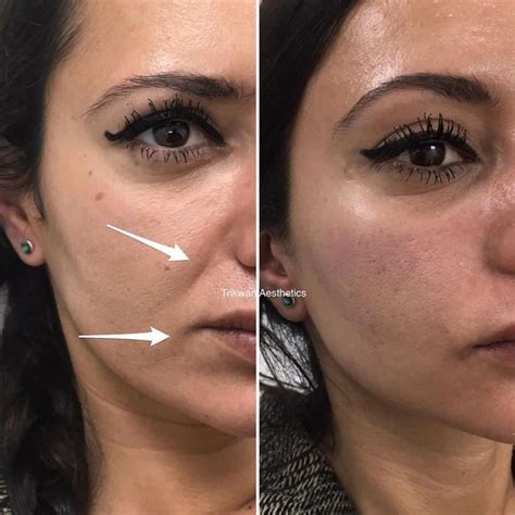 Dr Zoya Diwan On Instagram One Of Our Most Popular Transformations Remarkable How Correctly