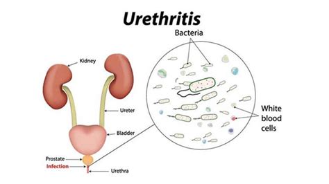 10 Home Remedies for Urethritis – Entirely Health