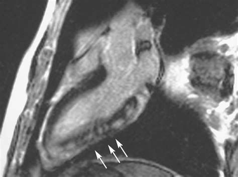 Acute Myocarditis Mri The Role Of Cardiovascular Magnetic Resonance