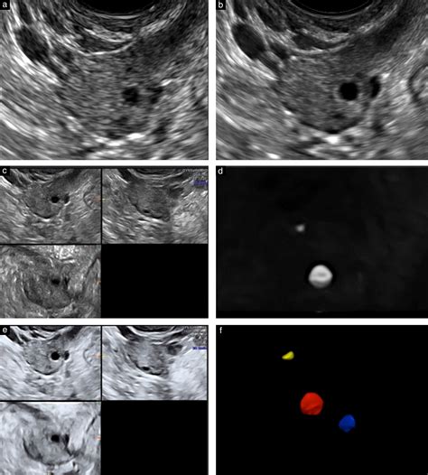 Ovarian Follicle Ultrasound