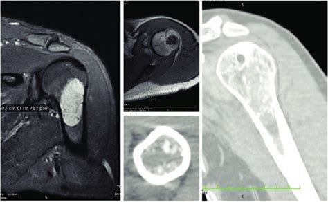 Chondrosarcoma Mri