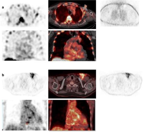 99mTc HMPAO WBC a and ¹⁸F FDG PET CT b in patients with CIED