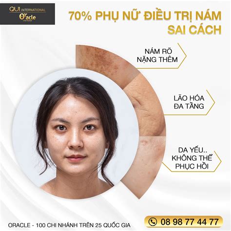 NHỮNG ĐIỀU CẦN BIẾT ĐỂ ĐIỀU TRỊ NÁM HIỆU QUẢ